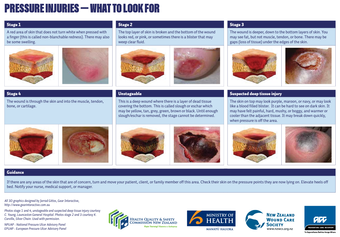 Bedsores | Fight Nursing Home Abuse | Free Consultation